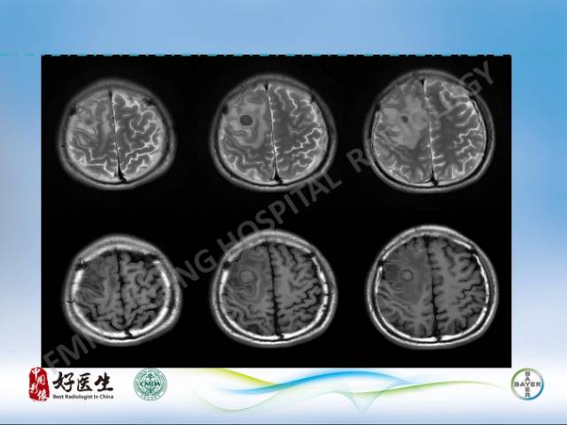 【病例】闹结核瘤1例MR影像特点