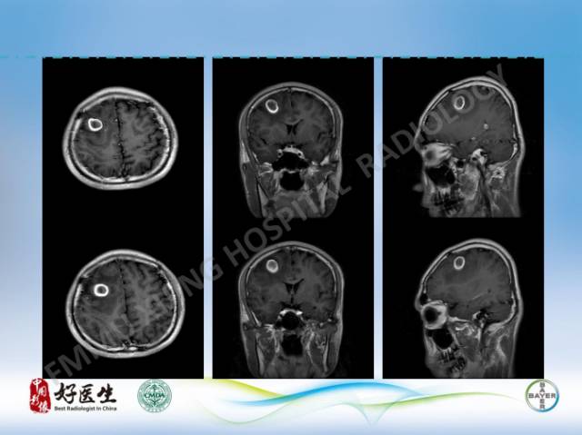 【病例】闹结核瘤1例MR影像特点