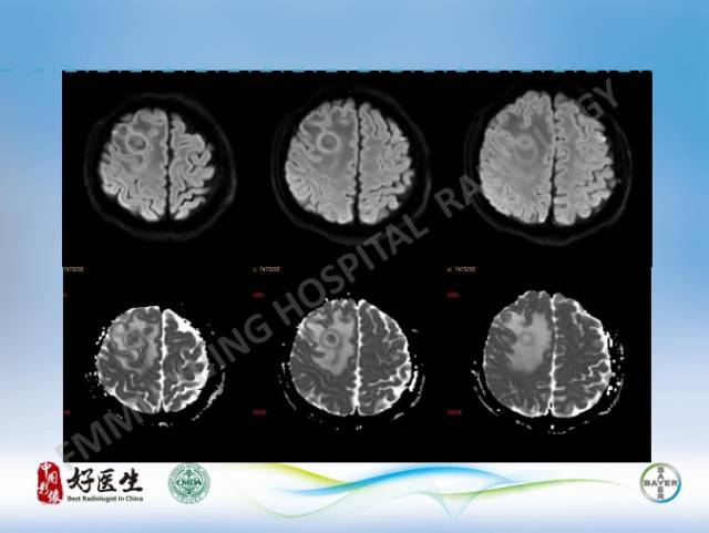 【病例】闹结核瘤1例MR影像特点