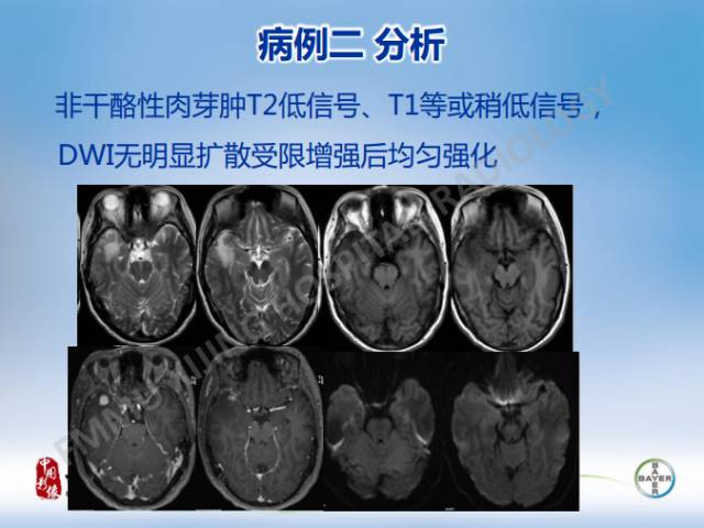 【病例】闹结核瘤1例MR影像特点