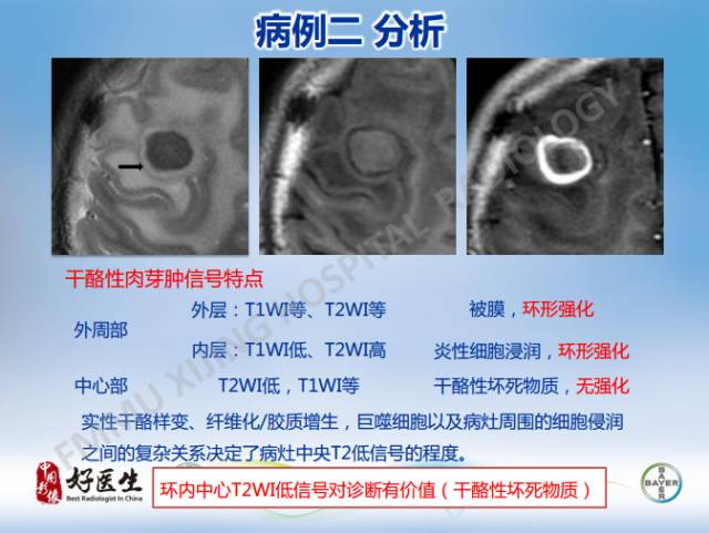 【病例】闹结核瘤1例MR影像特点