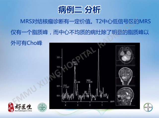 【病例】闹结核瘤1例MR影像特点