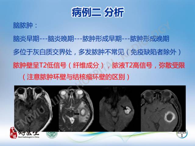 【病例】闹结核瘤1例MR影像特点