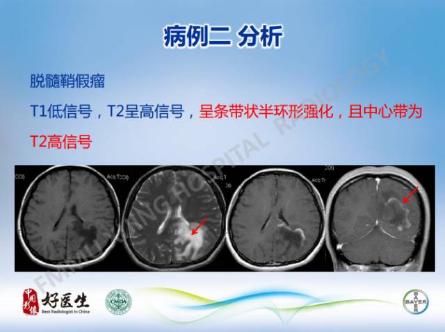 【病例】闹结核瘤1例MR影像特点
