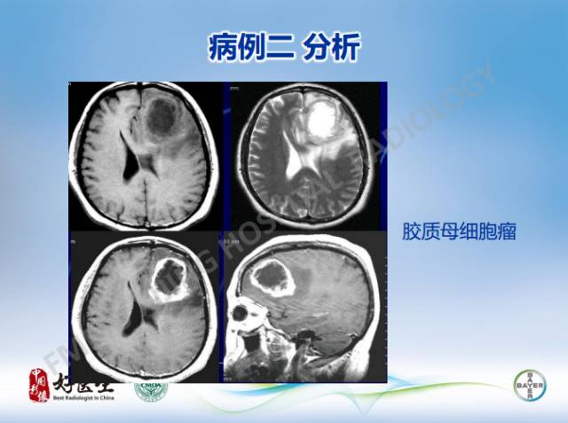 【病例】闹结核瘤1例MR影像特点
