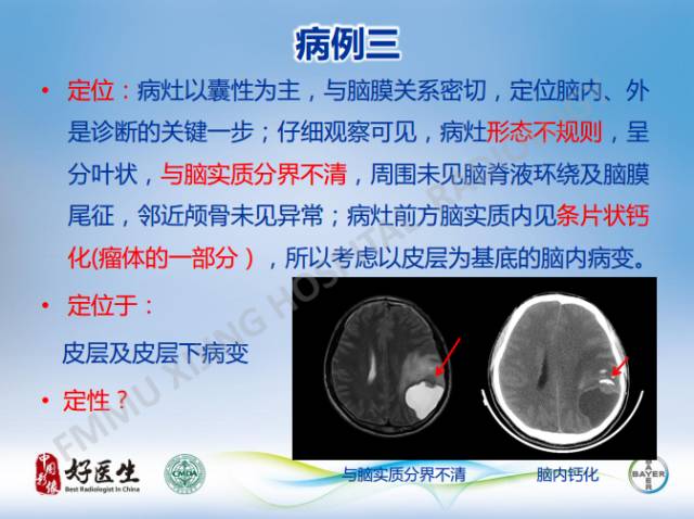 【病例】幕上室管膜瘤1例CT及MR影像表现