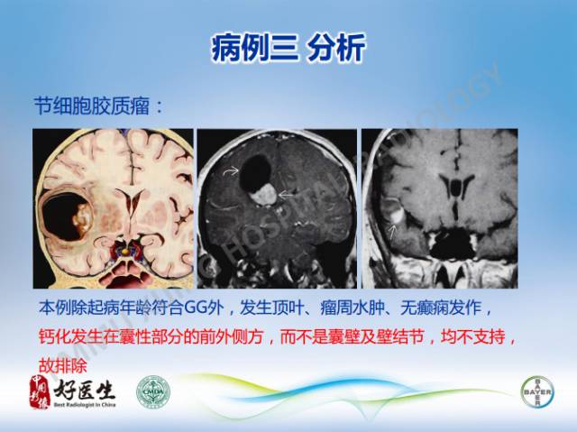 【病例】幕上室管膜瘤1例CT及MR影像表现