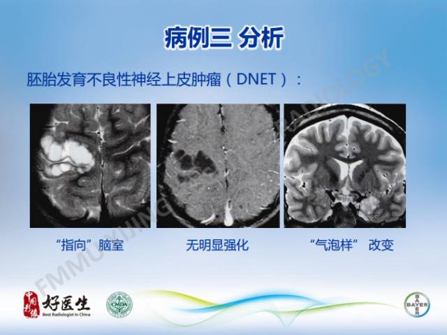 【病例】幕上室管膜瘤1例CT及MR影像表现
