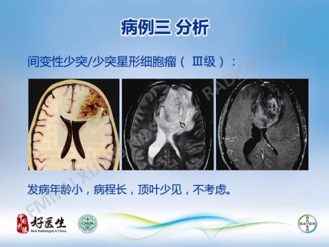 【病例】幕上室管膜瘤1例CT及MR影像表现