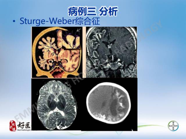 【病例】幕上室管膜瘤1例CT及MR影像表现