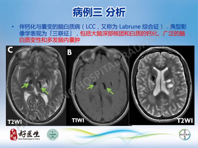【病例】幕上室管膜瘤1例CT及MR影像表现
