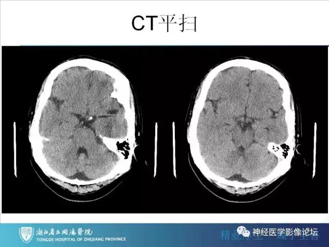 【罕见病例】脑膜血管瘤病1例CT及MR影像表现