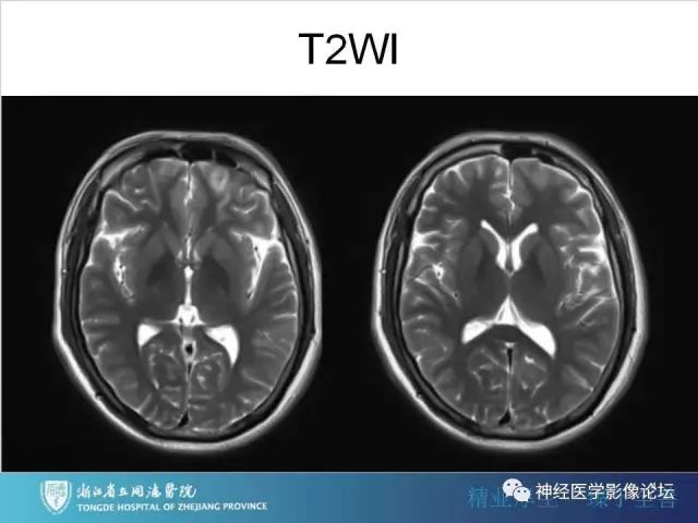 【罕见病例】脑膜血管瘤病1例CT及MR影像表现