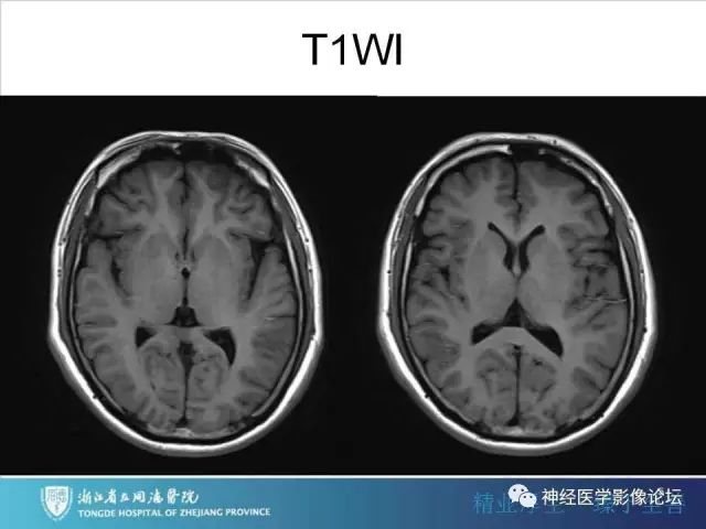 【罕见病例】脑膜血管瘤病1例CT及MR影像表现