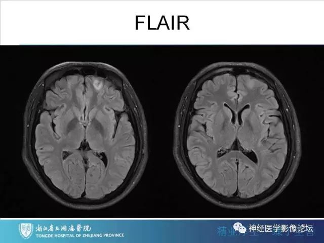 【罕见病例】脑膜血管瘤病1例CT及MR影像表现