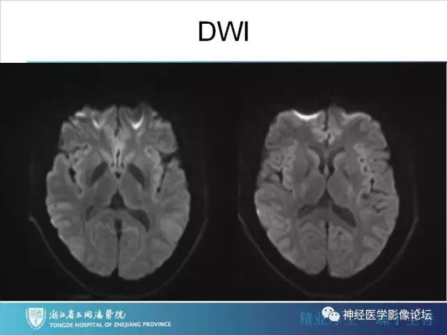 【罕见病例】脑膜血管瘤病1例CT及MR影像表现