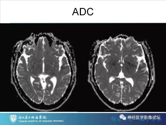 【罕见病例】脑膜血管瘤病1例CT及MR影像表现