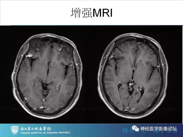 【罕见病例】脑膜血管瘤病1例CT及MR影像表现