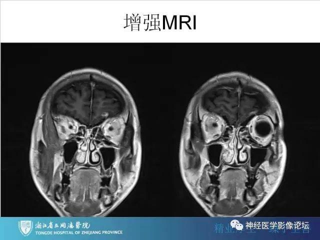 【罕见病例】脑膜血管瘤病1例CT及MR影像表现