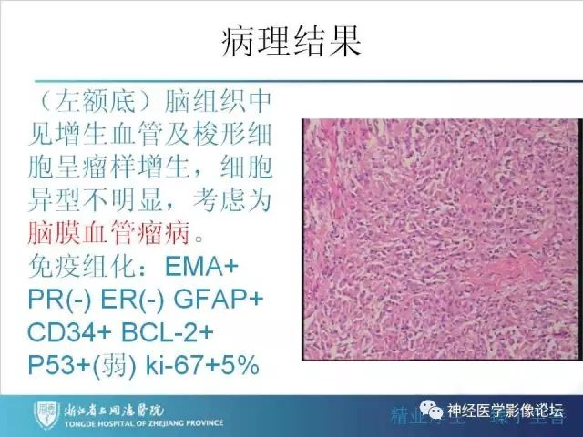 【罕见病例】脑膜血管瘤病1例CT及MR影像表现