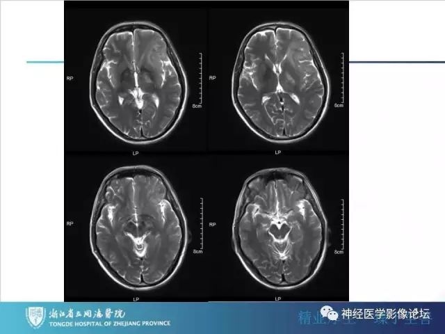 【病例】左额叶