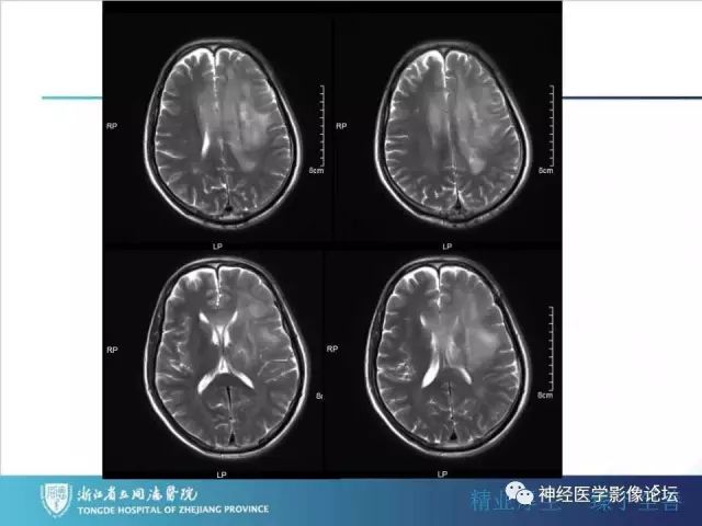 【病例】左额叶