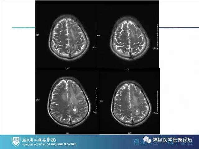 【病例】左额叶