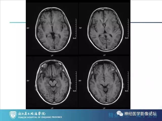 【病例】左额叶