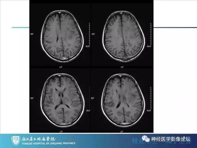 【病例】左额叶