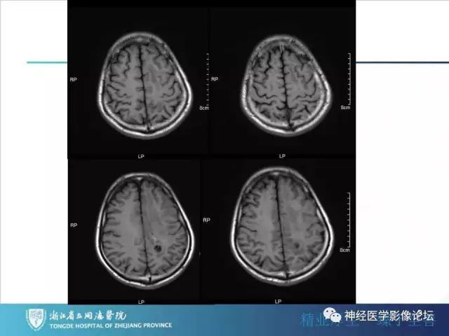 【病例】左额叶