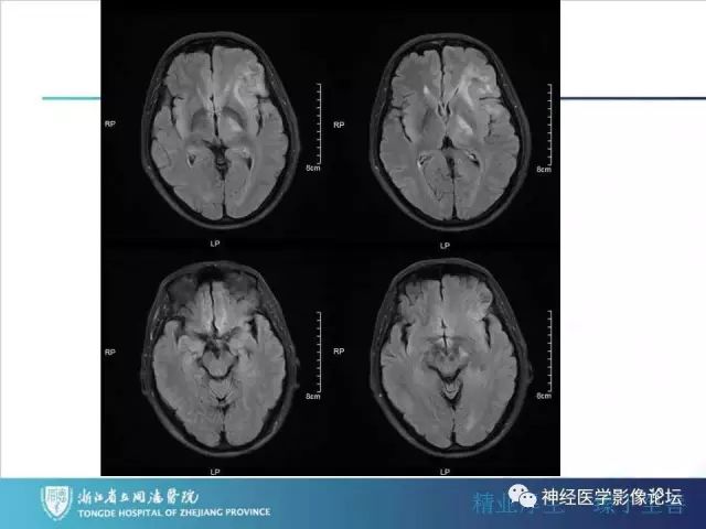 【病例】左额叶