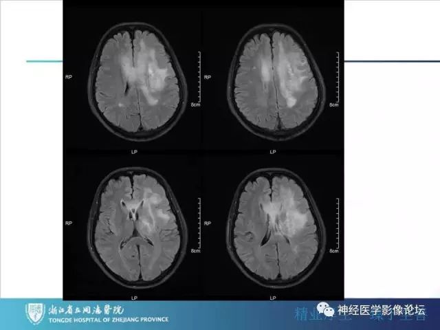 【病例】左额叶