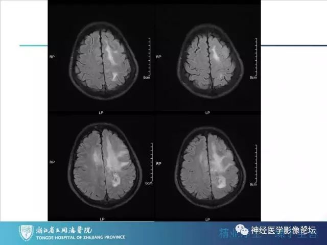 【病例】左额叶