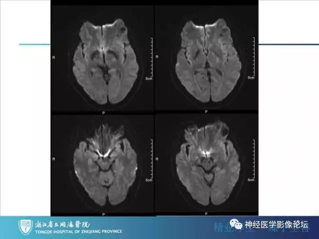 【病例】左额叶