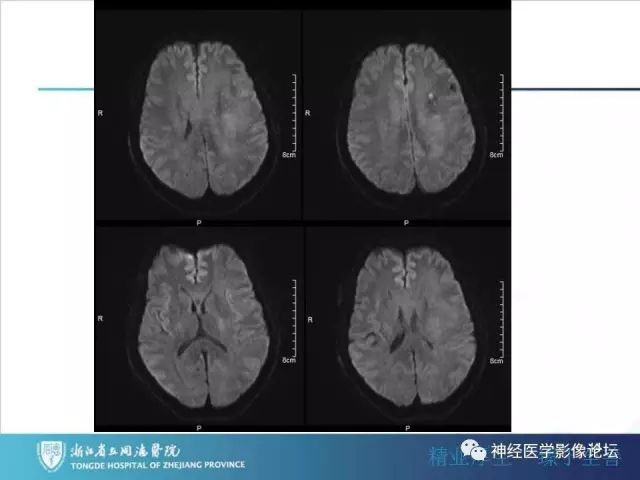 【病例】左额叶