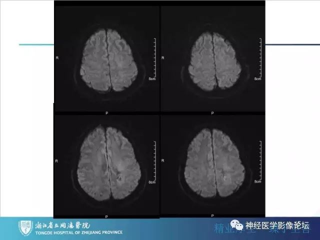 【病例】左额叶