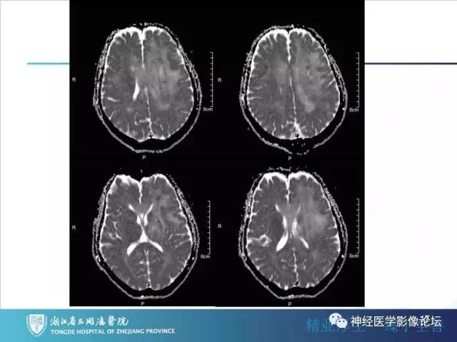 【病例】左额叶