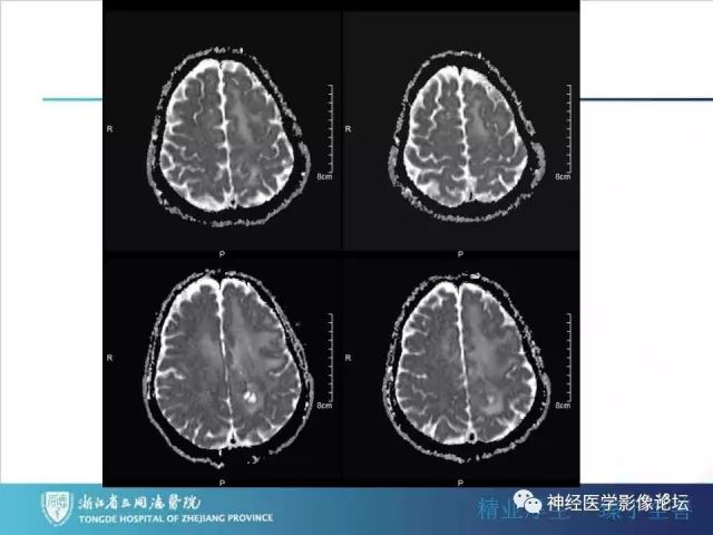 【病例】左额叶
