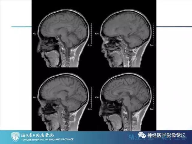 【病例】左额叶
