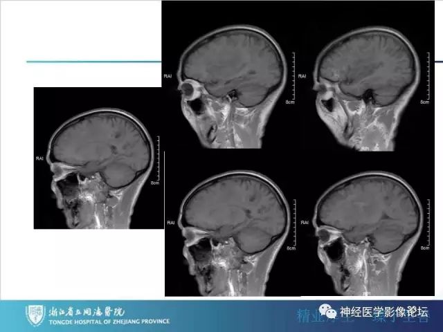 【病例】左额叶