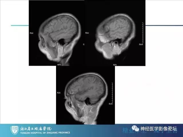 【病例】左额叶