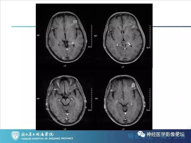 【病例】左额叶