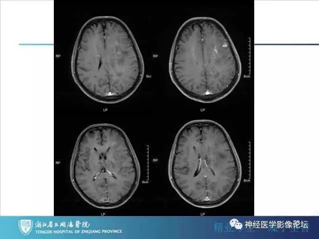 【病例】左额叶