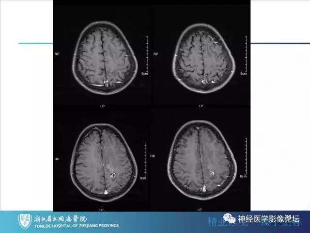 【病例】左额叶