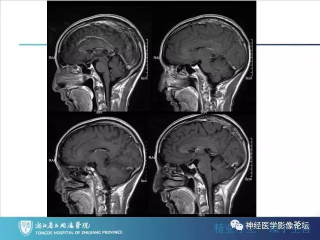 【病例】左额叶