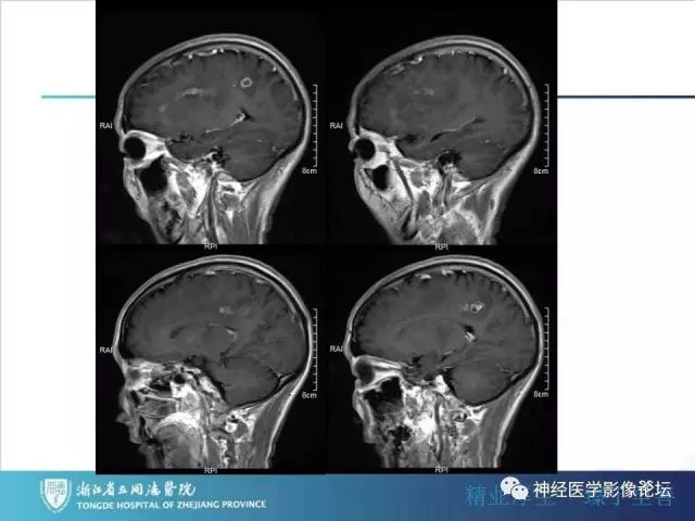 【病例】左额叶