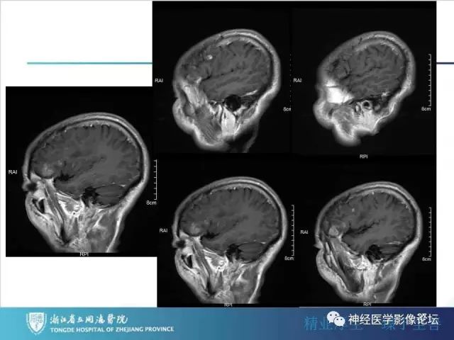 【病例】左额叶