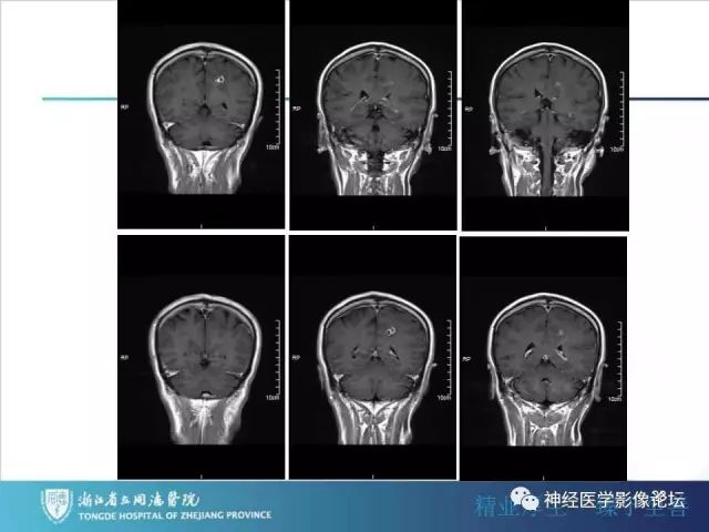 【病例】左额叶