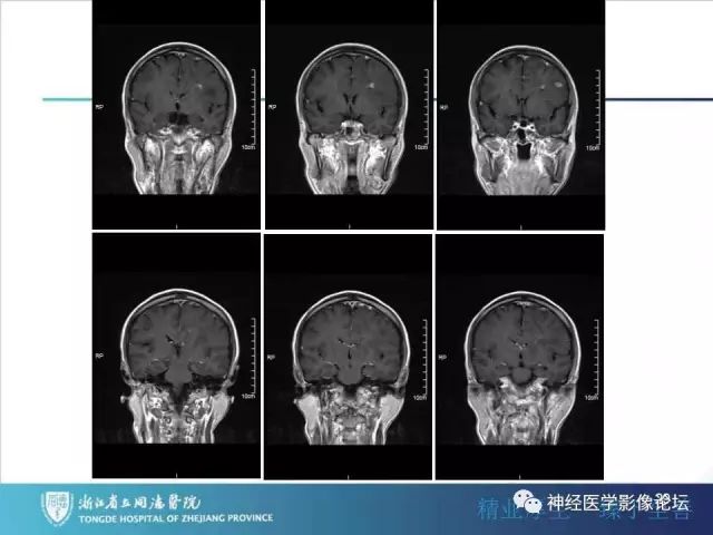 【病例】左额叶