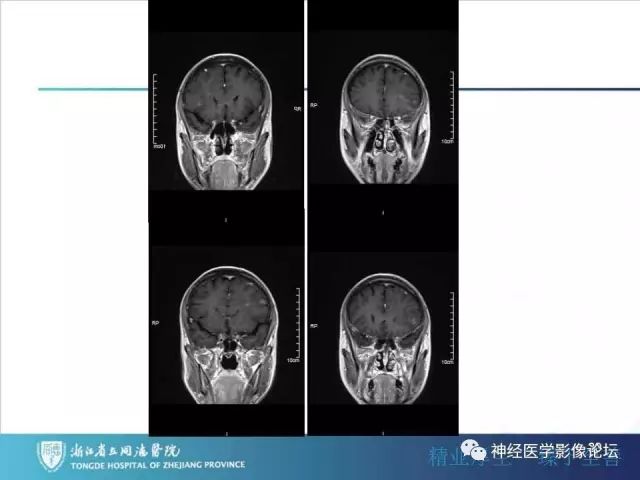 【病例】左额叶